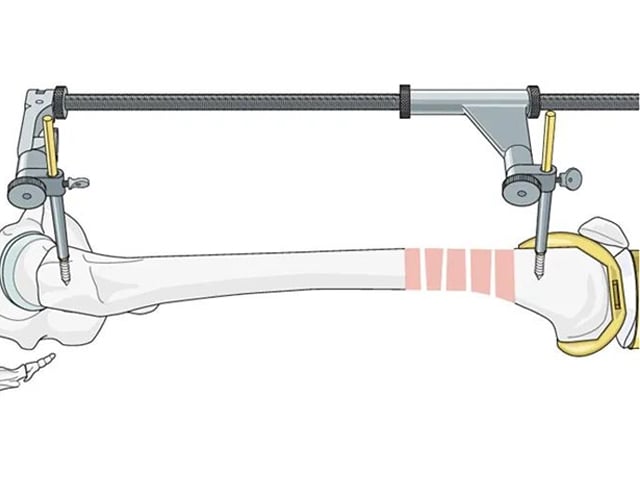Retrograde Intramedullary Nailing for Periprosthetic Femoral Fractures After TKA