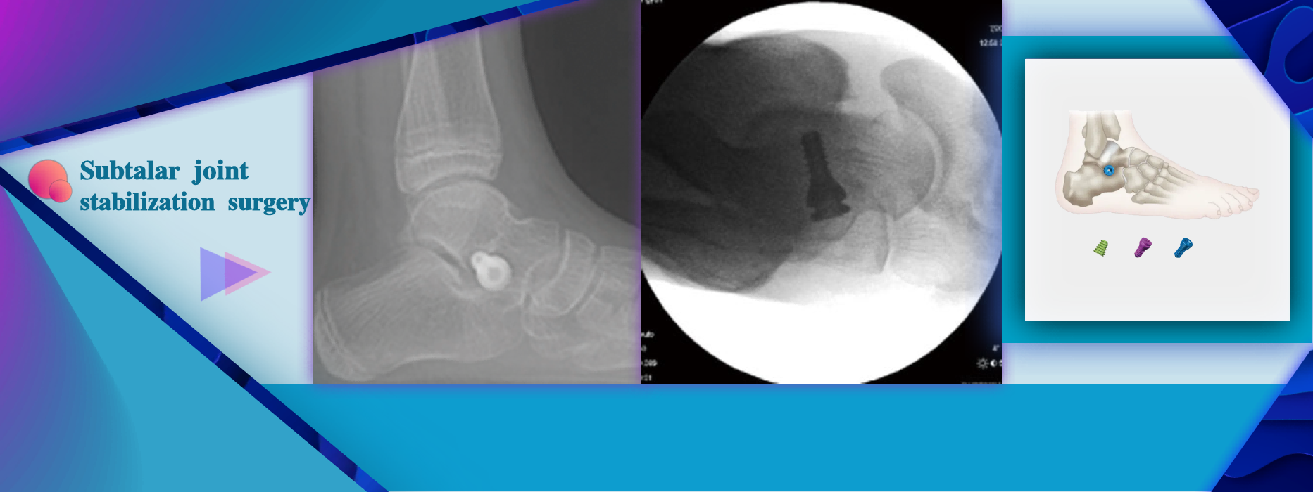 Subtalar Joint Immobilization and Stabilization Surgery using CareFix Arthroereisis Implants