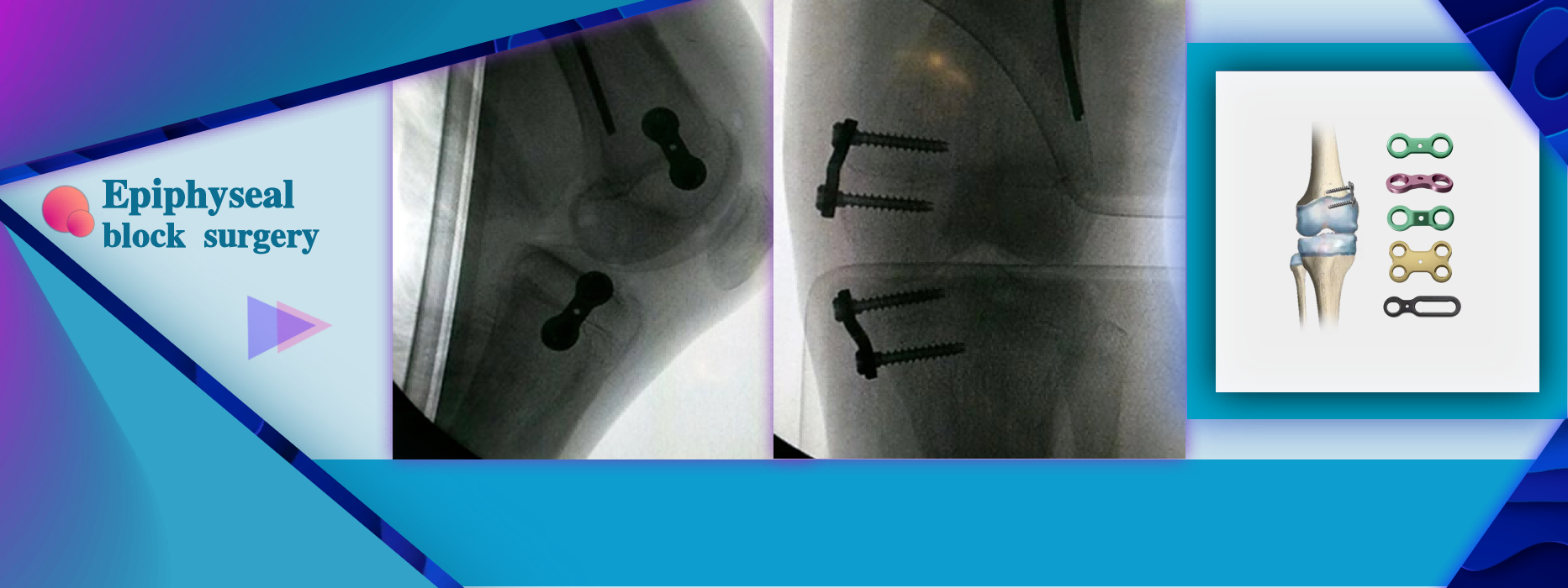 Half Epiphyseal Block Surgery