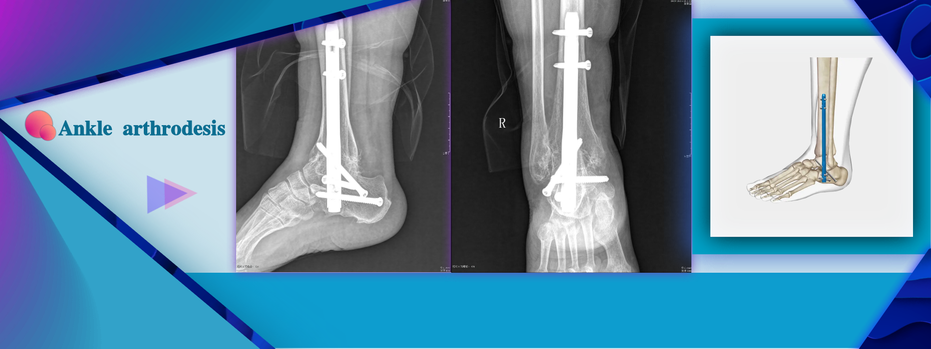 Ankle Arthrodesis Intramedullary Nail System