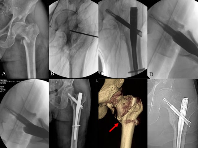 Characteristics and Surgical Techniques of the Double-Intra Irreducible Intertrochanteric Fractures