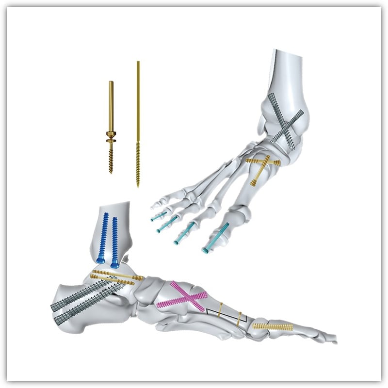 CareFix Cortical Bone Screws and Surgical Screws Range