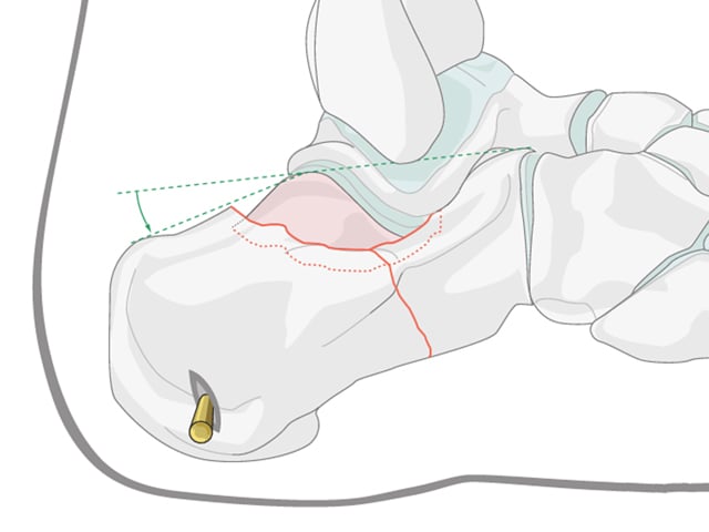 Minimally Invasive K-Wire and Screw Fixation for Calcaneal Fractures