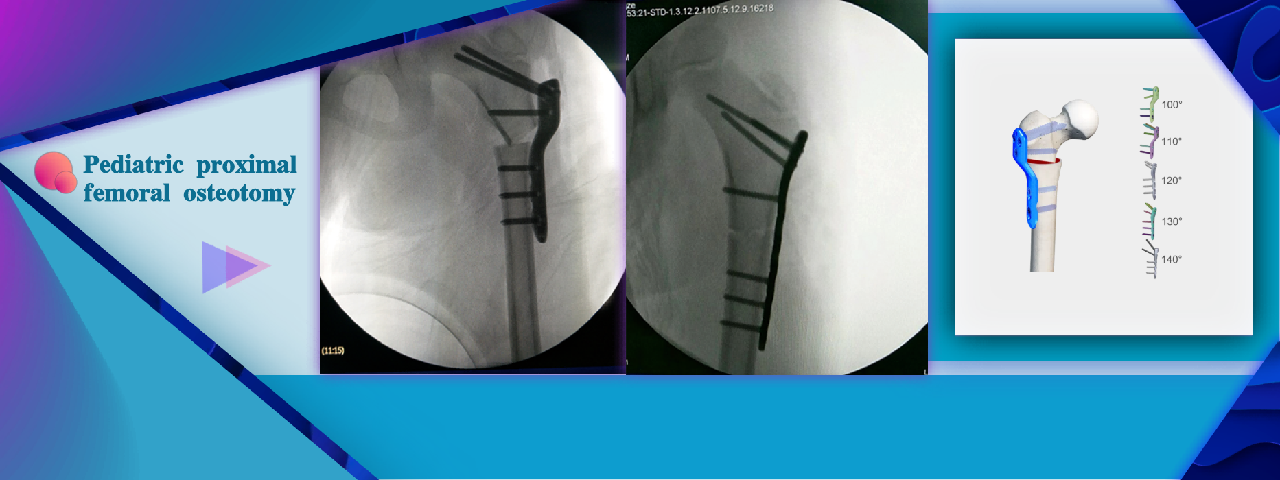 CareFix Pediatric & Small Bone Unilateral Fixator