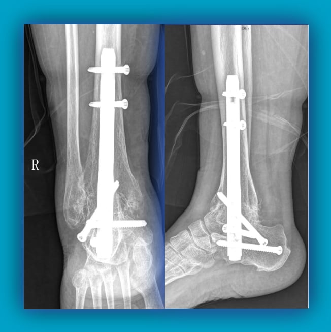 Ankle Arthrodesis External and Internal Fixation