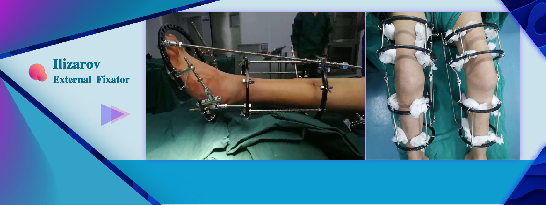 CareFix Rail-Type Bone Transport Unilateral External Fixator