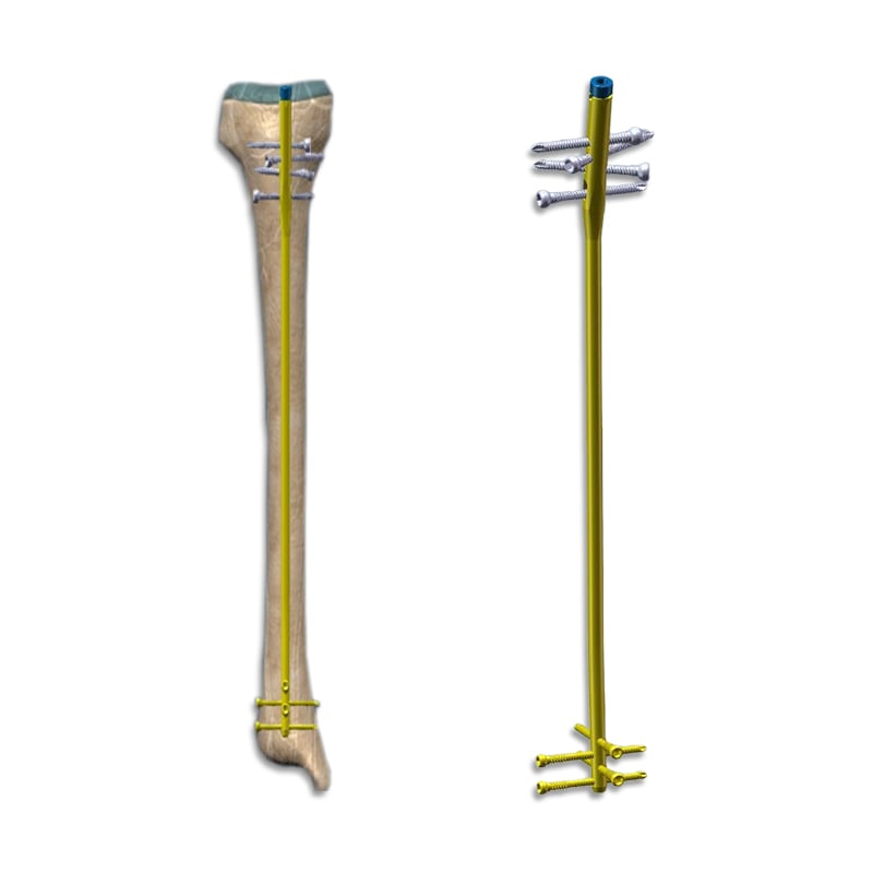 Pediatric Tibial Interlocking Nail