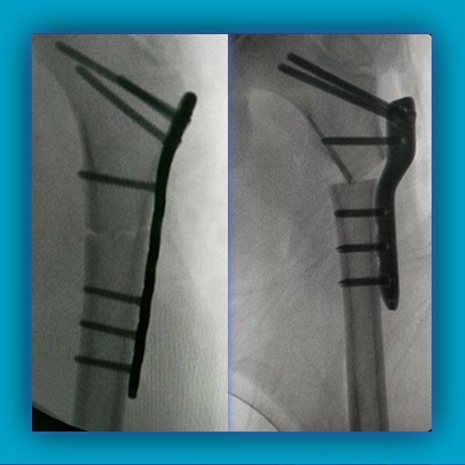 Pediatric Proximal Femoral Osteotomy Implants
