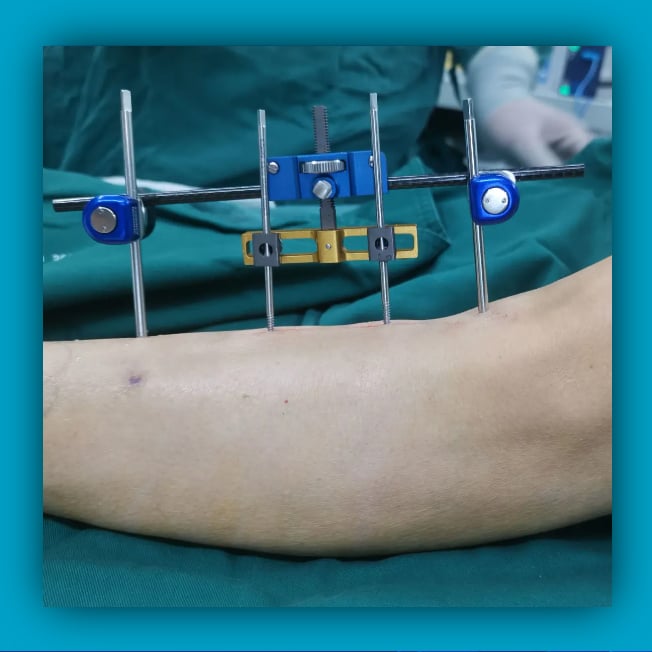 Lateral Tibial Bone Transfer Surgery (Tibial Cortex Transposition)