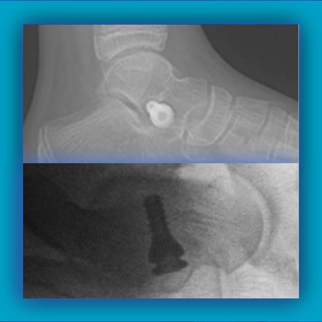 Subtalar Joint Fixation Surgery Implants