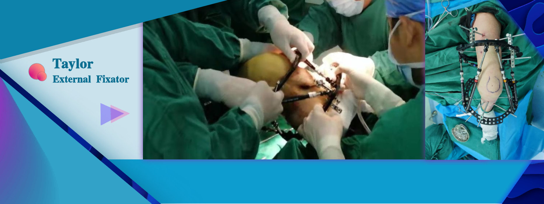 Bone Deformity Correction Surgery using External Fixators